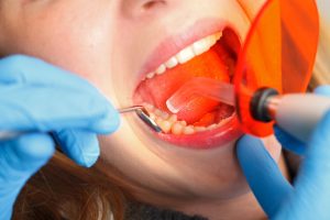 Dental filling procedure