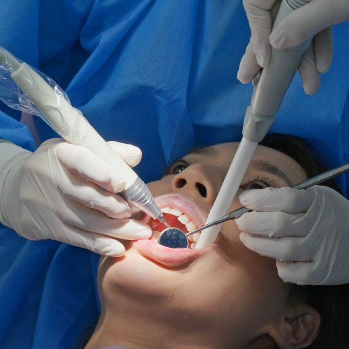 Dental hygiene cleaning